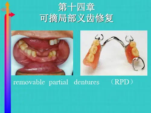 可摘局部义齿修复