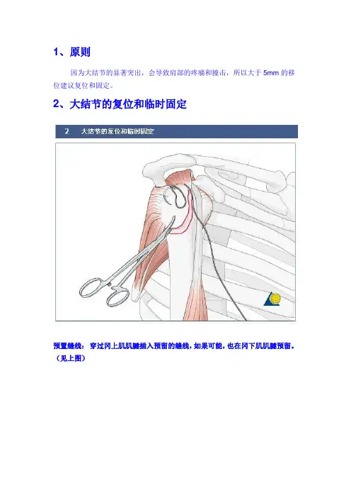 手术-肱骨近端骨折A1.2型切开复位内固定术