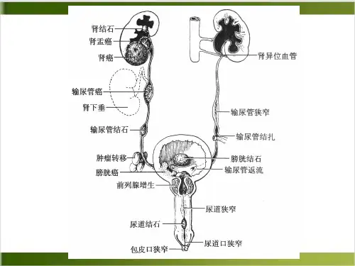 泌尿系统梗阻疾病病人的护理PPT课件