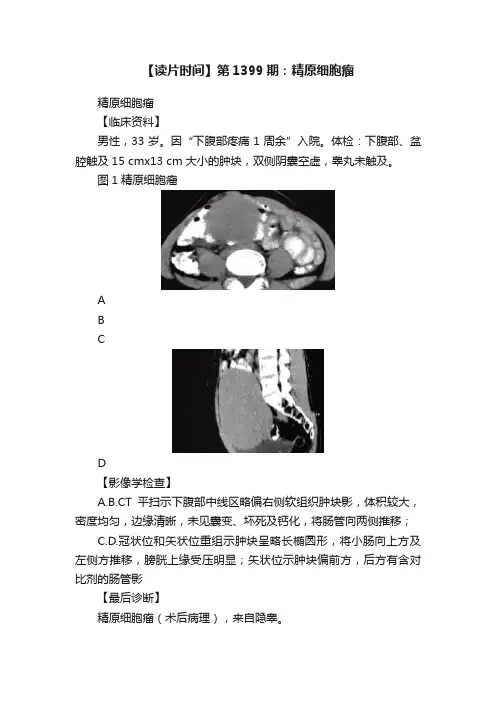【读片时间】第1399期：精原细胞瘤