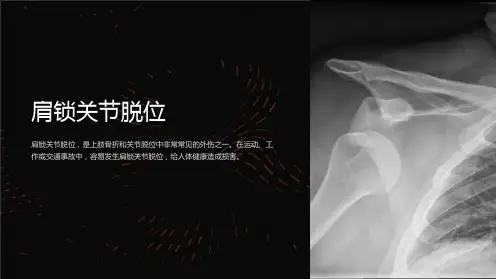 《肩锁关节脱位》课件 (2)