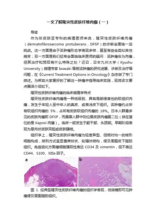 一文了解隆突性皮肤纤维肉瘤（一）