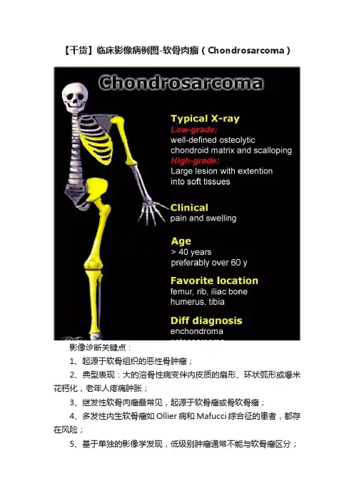 【干货】临床影像病例图-软骨肉瘤（Chondrosarcoma）
