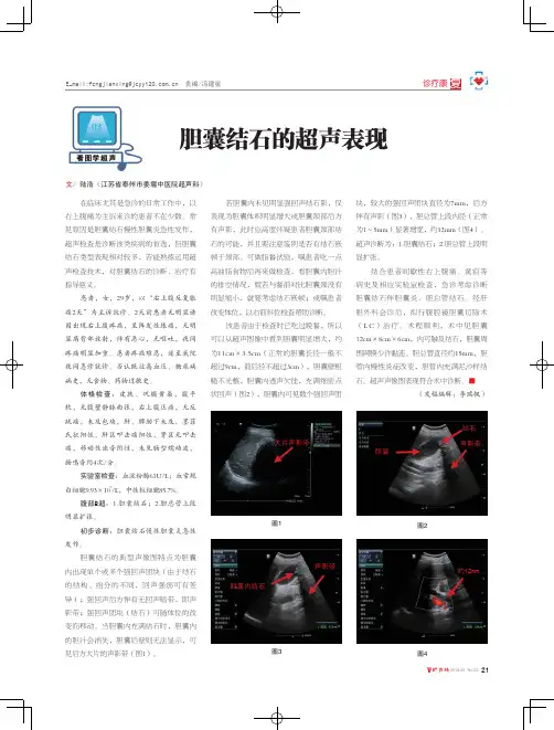 胆囊结石的超声表现