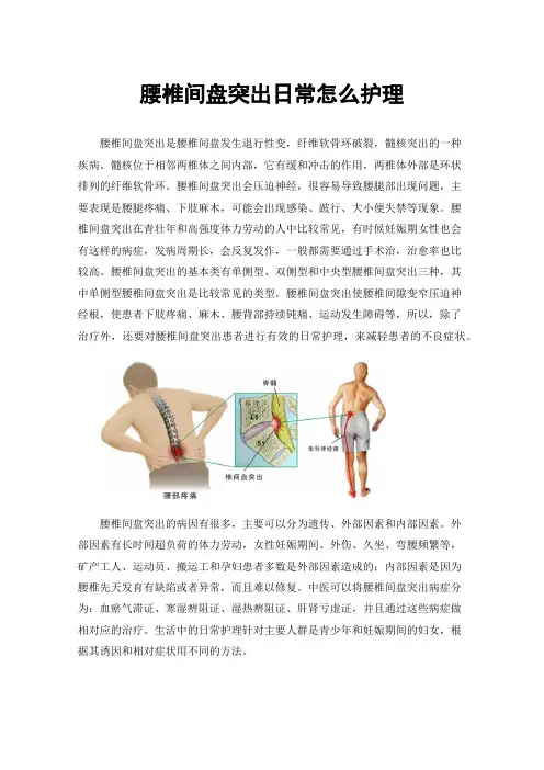 腰椎间盘突出日常怎么护理