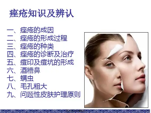 痤疮专业知识PPT课件