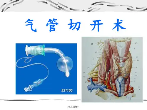 气管切开术.