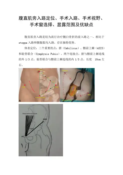 腹直肌旁入路定位、手术入路、手术视野、手术窗选择、显露范围及优缺点