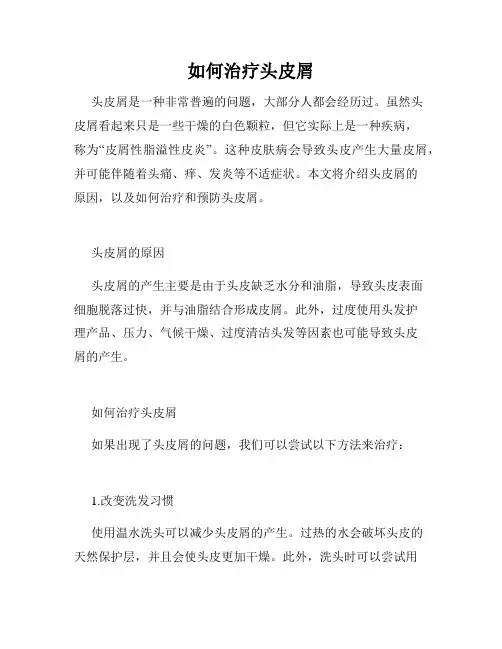 如何治疗头皮屑