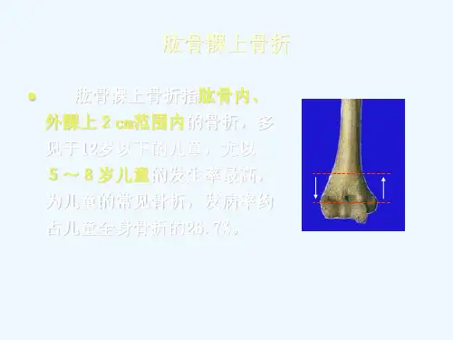 肱骨髁上骨折 ppt课件