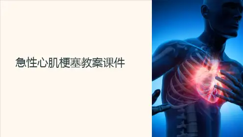 急性心肌梗塞教案课件