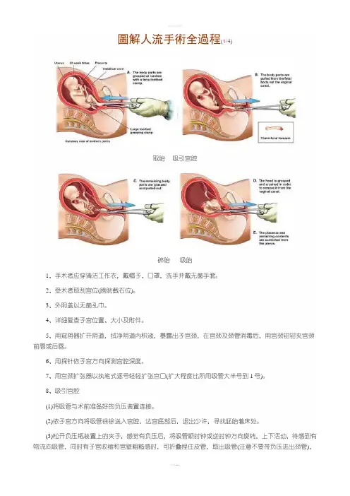 图解人流手术全过程