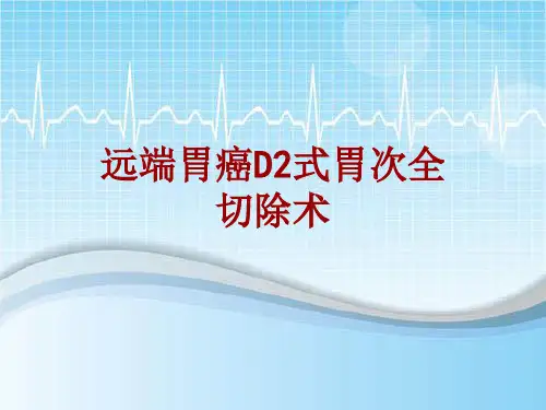 手术讲解模板：远端胃癌D2式胃次全切除术