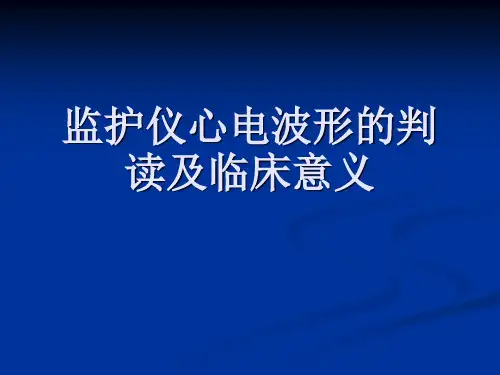 监护仪心电波形的
