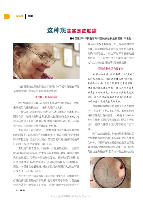 这种斑其实是皮肤癌