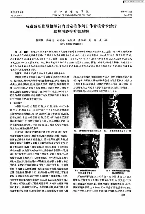 后路减压椎弓根螺钉内固定椎体间自体骨植骨术治疗腰椎滑脱症疗效观察