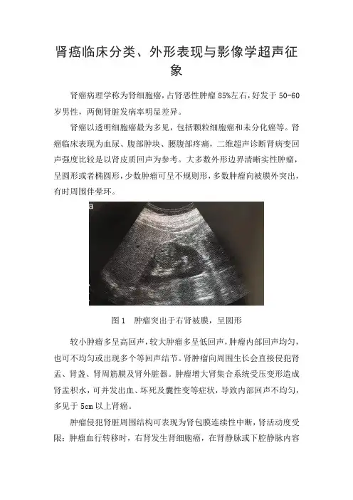 肾癌临床分类、外形表现与影像学超声征象