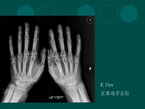医学影像学课件：骨关节疾病二