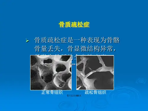 骨水泥治疗压缩骨折.pptx
