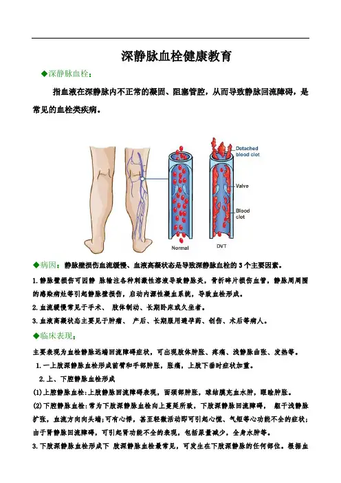 深静脉血栓健康教育