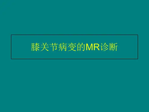 膝关节病变的MR诊断参考PPT