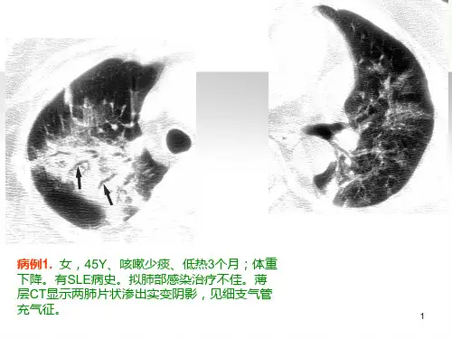 隐源性机化性肺炎的诊断进展-刘.ppt