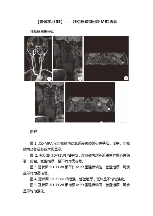 【影像学习35】——颈动脉易损斑块MRI表现