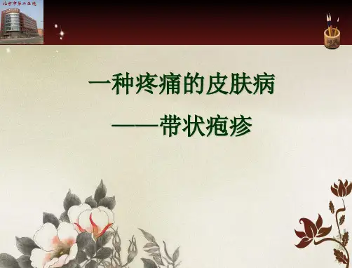带状疱疹中医治疗 PPT课件