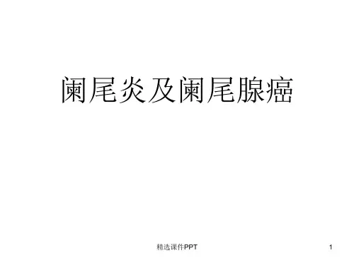 阑尾炎及阑尾肿瘤ppt课件