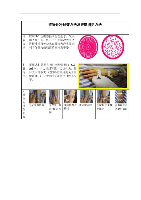 留置针冲封管方法及正确固定方法