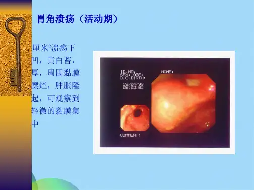 消化性溃疡详解(共51张PPT)