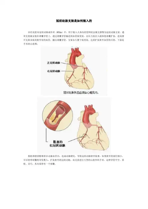 冠状动脉支架是如何植入的