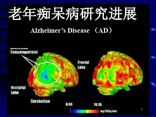 老年痴呆病研究进展PPT课件
