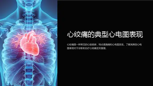 心绞痛的典型心电图表现