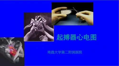 常见起搏器心电图解读