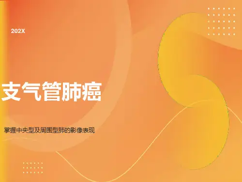 肺癌影像学表现PPT