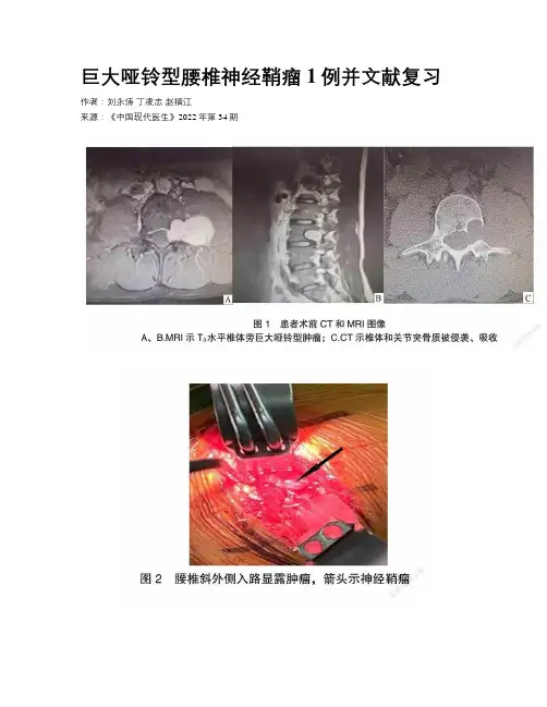 巨大哑铃型腰椎神经鞘瘤1例并文献复习