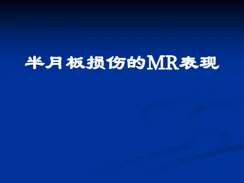 半月板损伤的MR检查