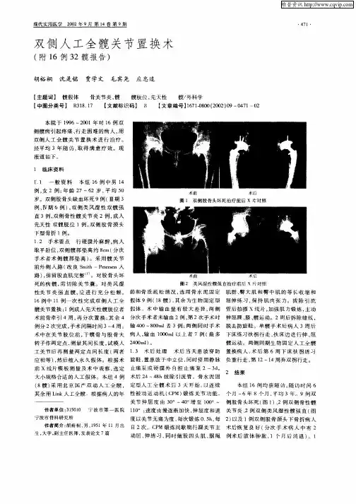 双侧人工全髋关节置换术(附16例32髋报告)