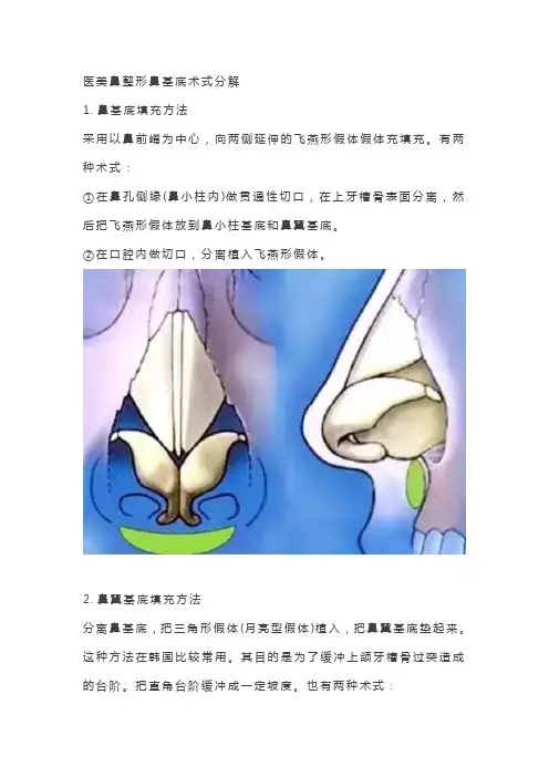 医美鼻整形鼻基底术式分解