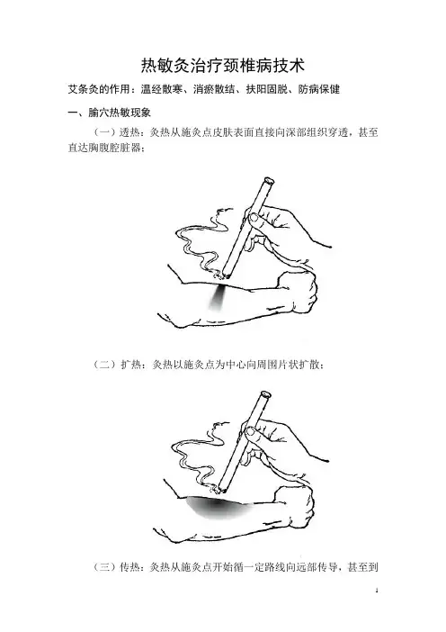 热敏灸