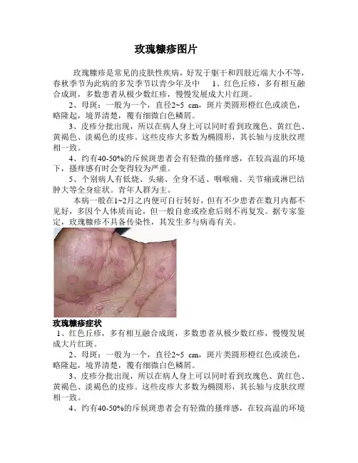 玫瑰糠疹图片