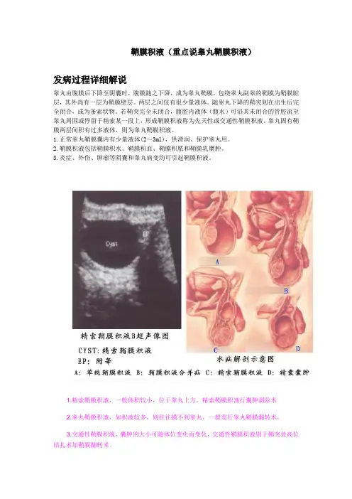 鞘膜积液翻转术：鞘膜积液