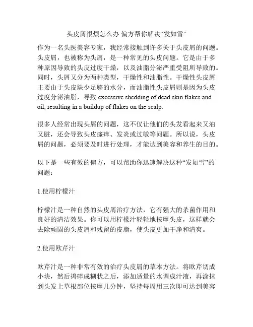头皮屑很烦怎么办 偏方帮你解决“发如雪”