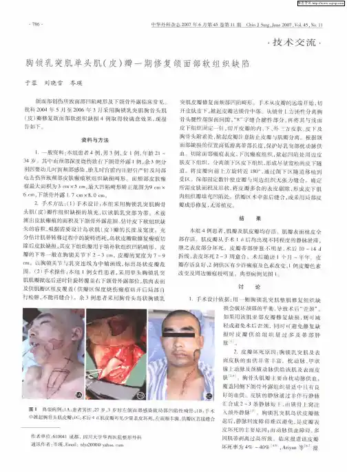 胸锁乳突肌单头肌(皮)瓣一期修复颌面部软组织缺陷