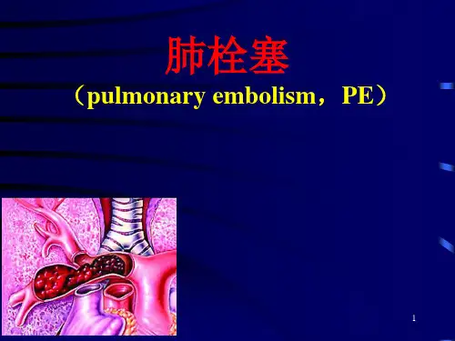 肺栓塞讲课和上腔静脉压迫综合征