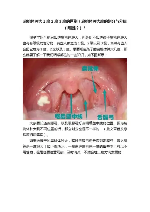 扁桃体肿大1度2度3度的区别？扁桃体肿大度的划分与分级（附图片）！