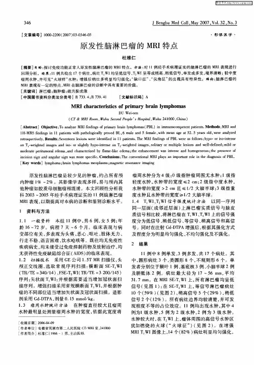 原发性脑淋巴瘤的MRI特点