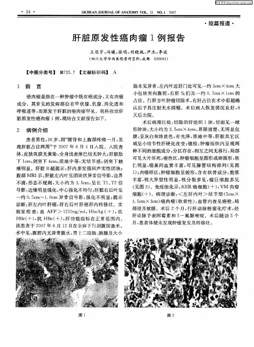 肝脏原发性癌肉瘤1例报告