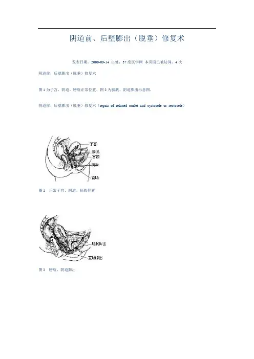 阴道前、后壁膨出(脱垂)修复术